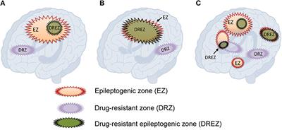 The Concept of Drug-Resistant Epileptogenic Zone